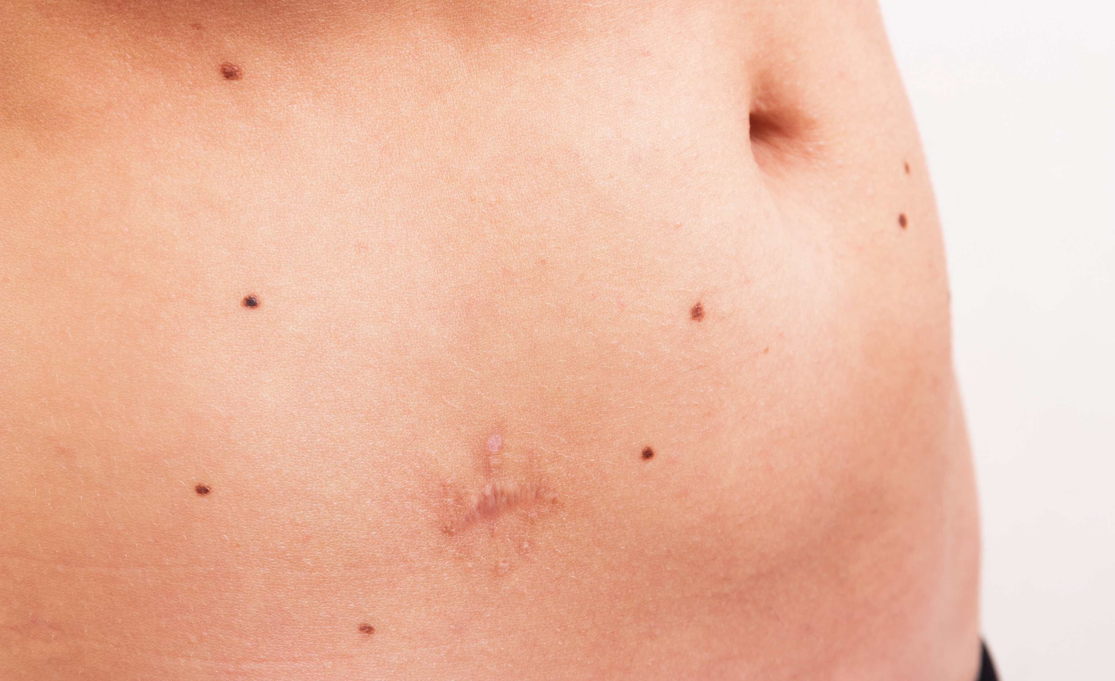 Sexy Folks Do Mole Removal :)