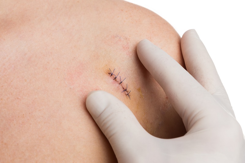 mole removal scar