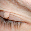 how to remove skin tag eyelid