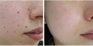mole removal before after