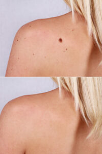 mole removal San Francisco before and after