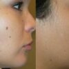 Radiofrequency Mole Removal in Las Vegas, NV