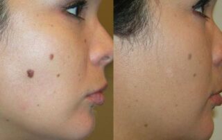Radiofrequency Mole Removal in Las Vegas, NV
