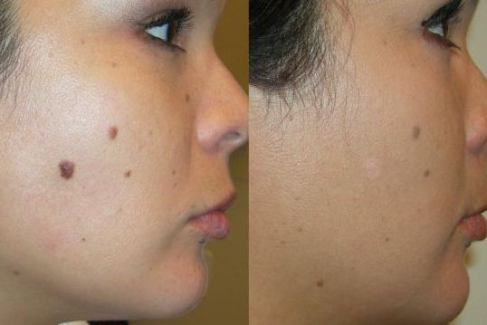 Radiofrequency Mole Removal in Las Vegas, NV