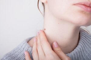 skin tag removal on neck
