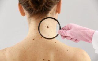best mole removal el centro