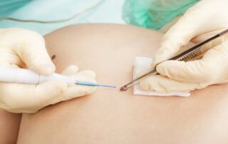 mole removal encinitas california