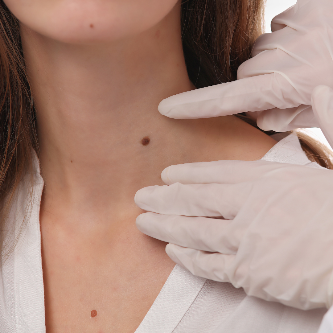 expert mole removal chula vista california