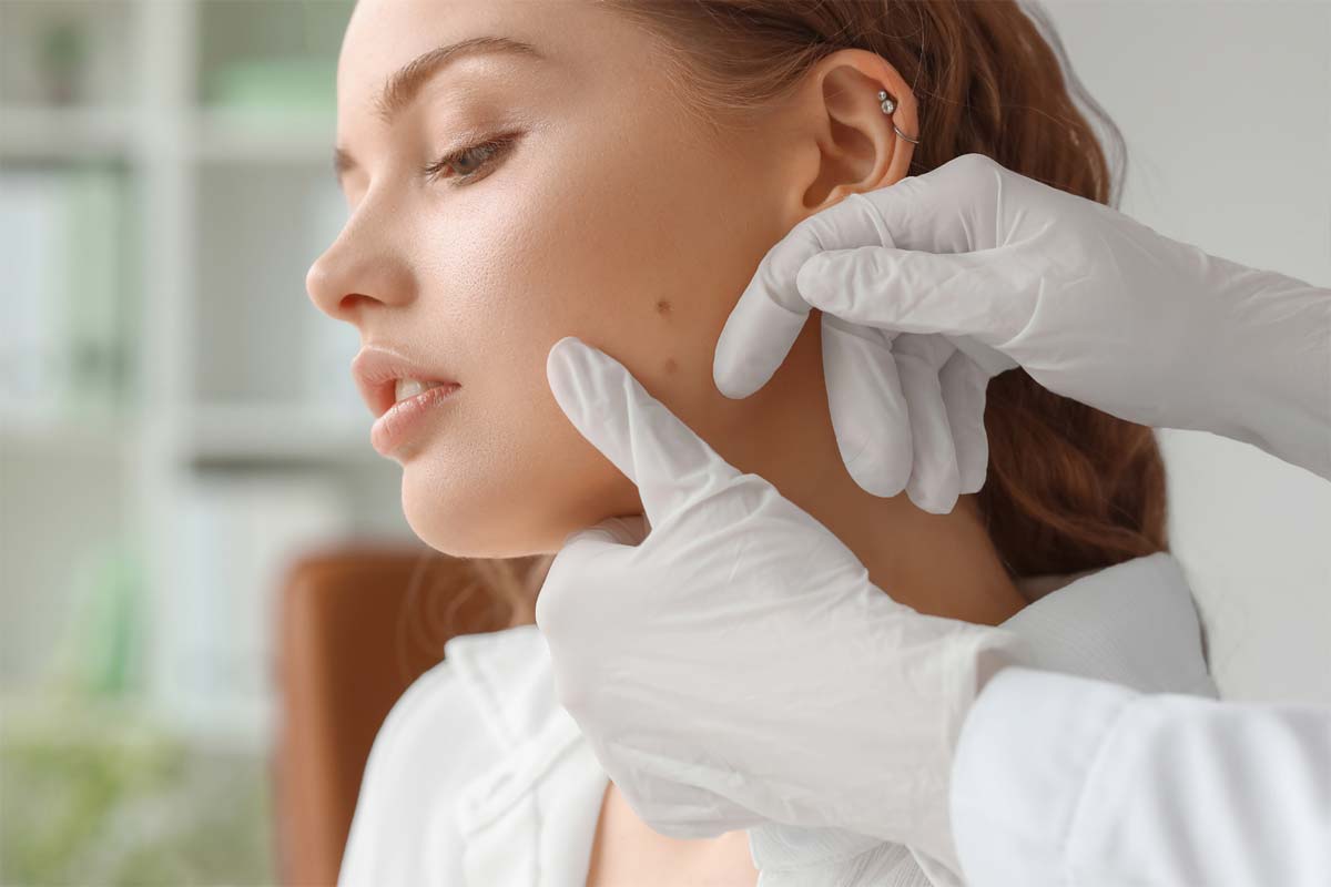 expert mole removal coronado california