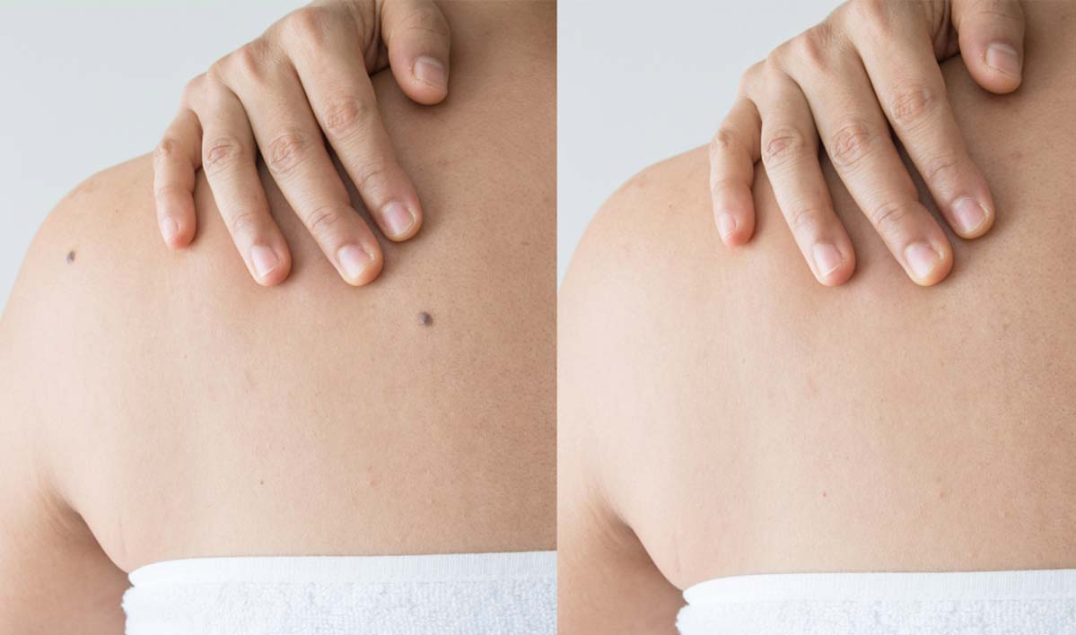 specialized mole removal coronado california