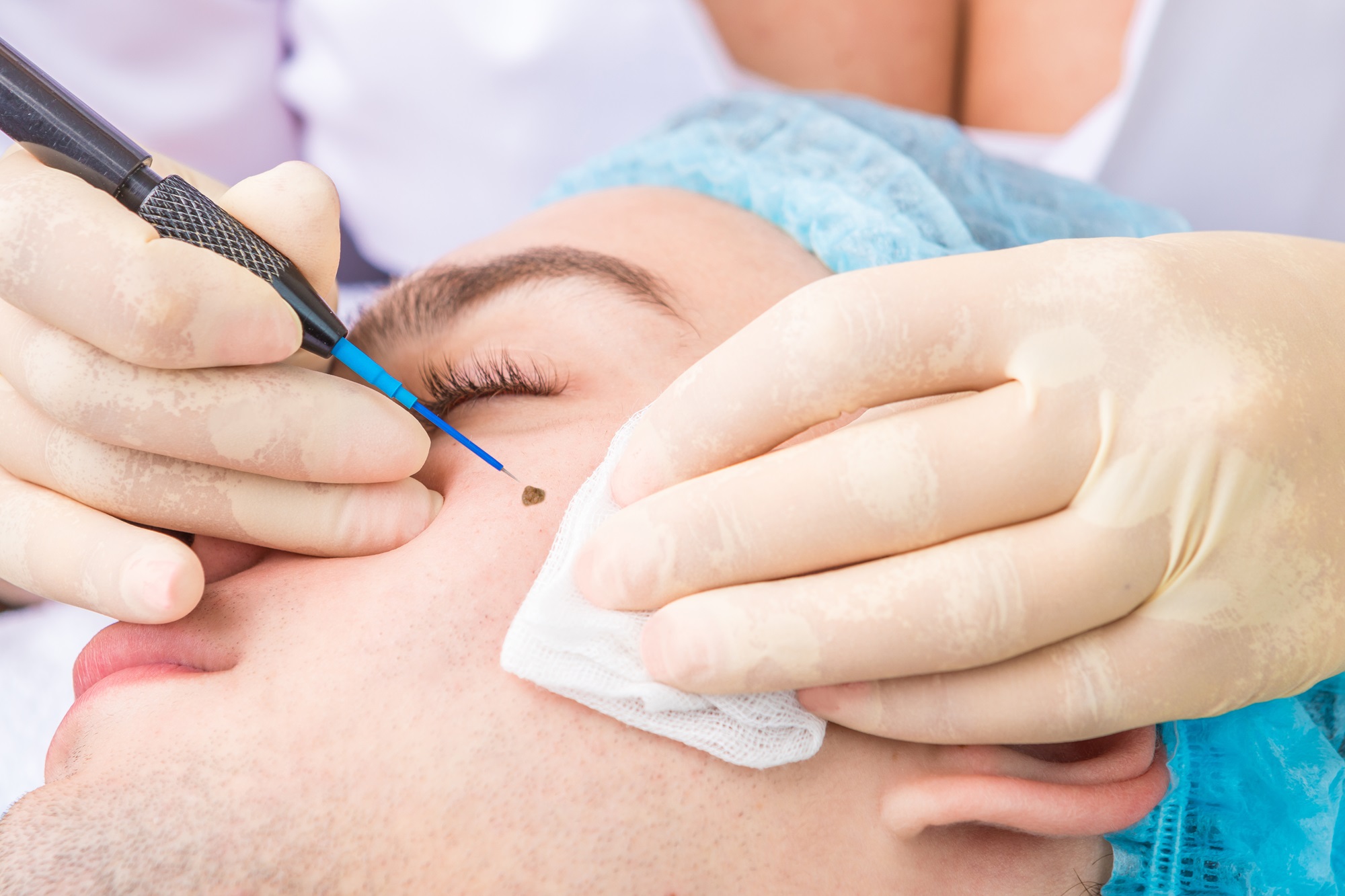 affordable mole removal Oceanside california