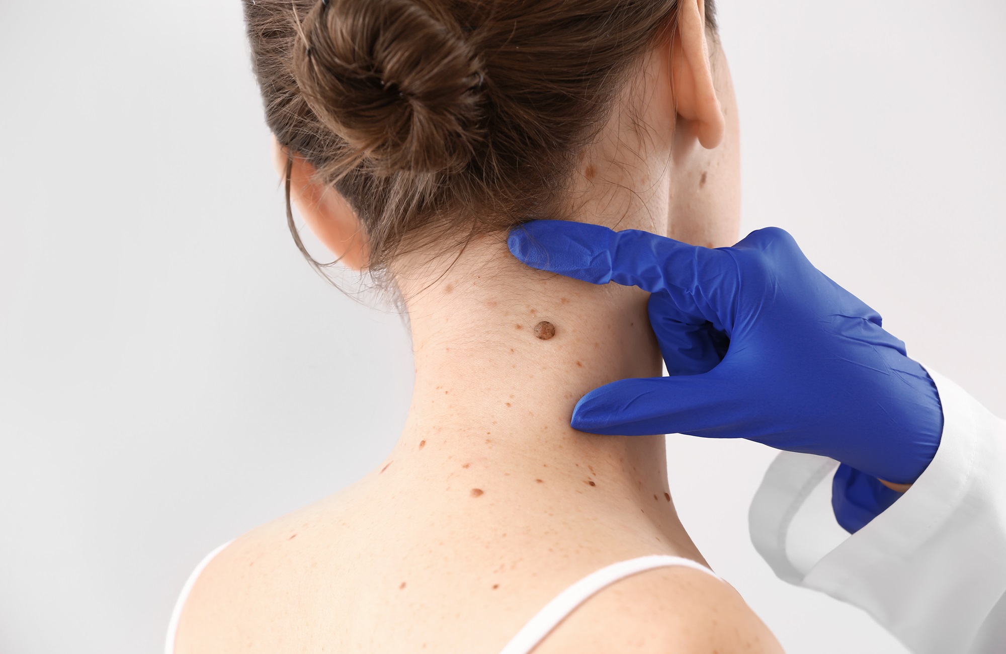 expert mole removal poway california