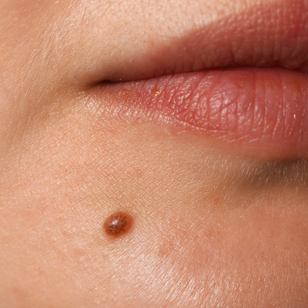 affordable mole removal Escondido California