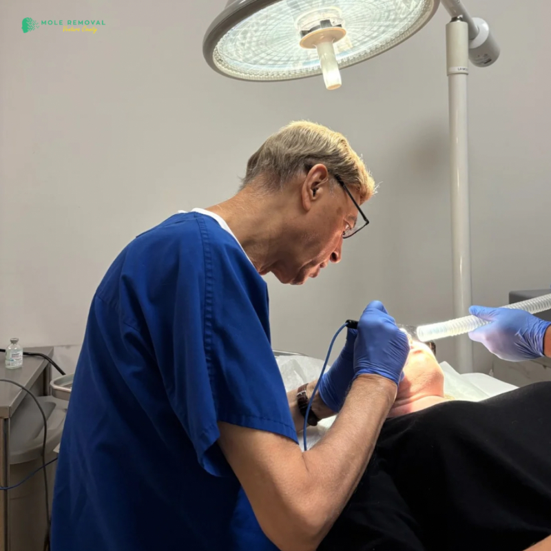 Learn More About Mole Removal San Diego 2 Get Smoother, Clearer Skin with Professional Mole Removal in San Diego 3