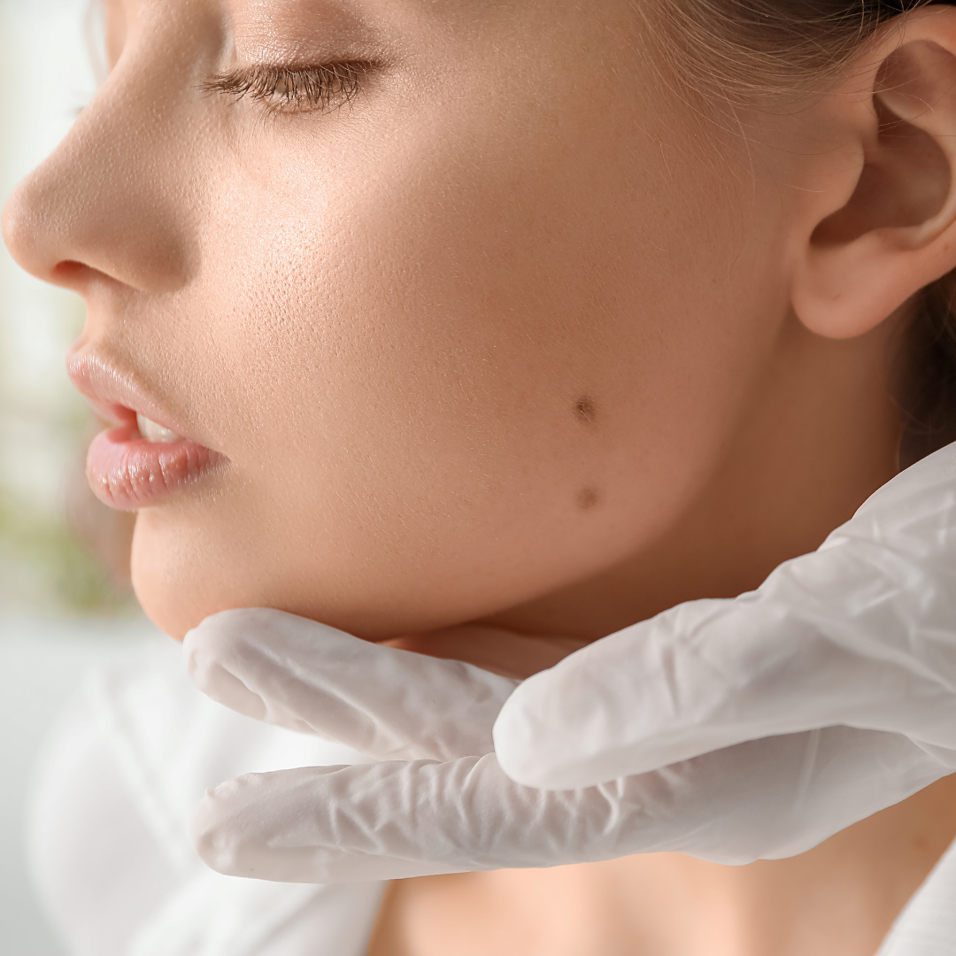 beauty mark removal san diego